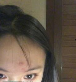 吃瓜会长痘嘛,揭秘瓜果摄入与皮肤健康的关系